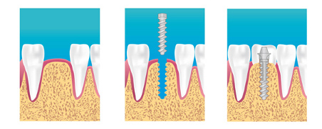 centre dentaire ermont eaubonne explication implant dentaire